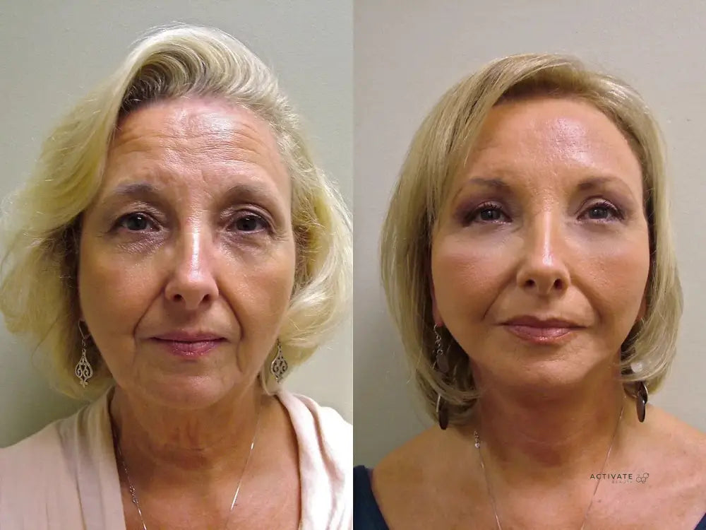 Liquid Facelift Skin Booster PLLA (Sculptra) + HA