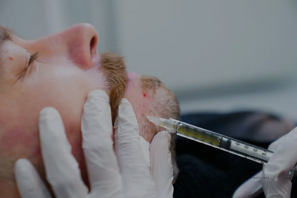 PRP & Mesotherapy for beard growth