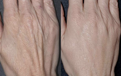 Skin Booster for the hands