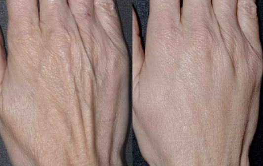 Skin Booster for the hands