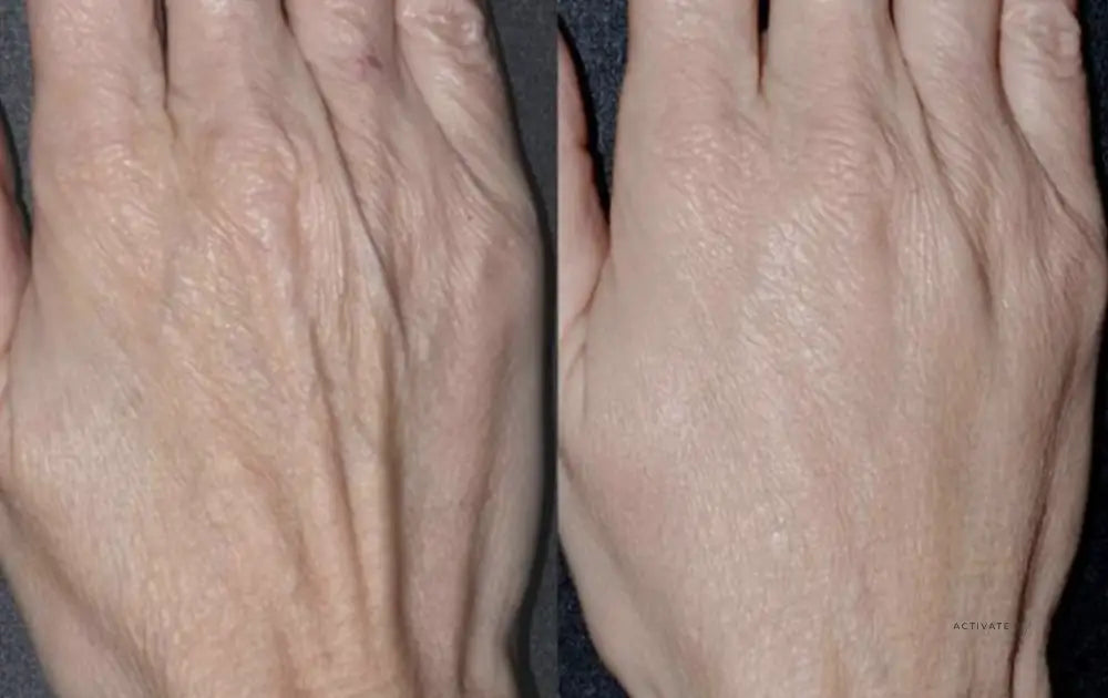 Biorevitalization Treatment For Hands Procedurs