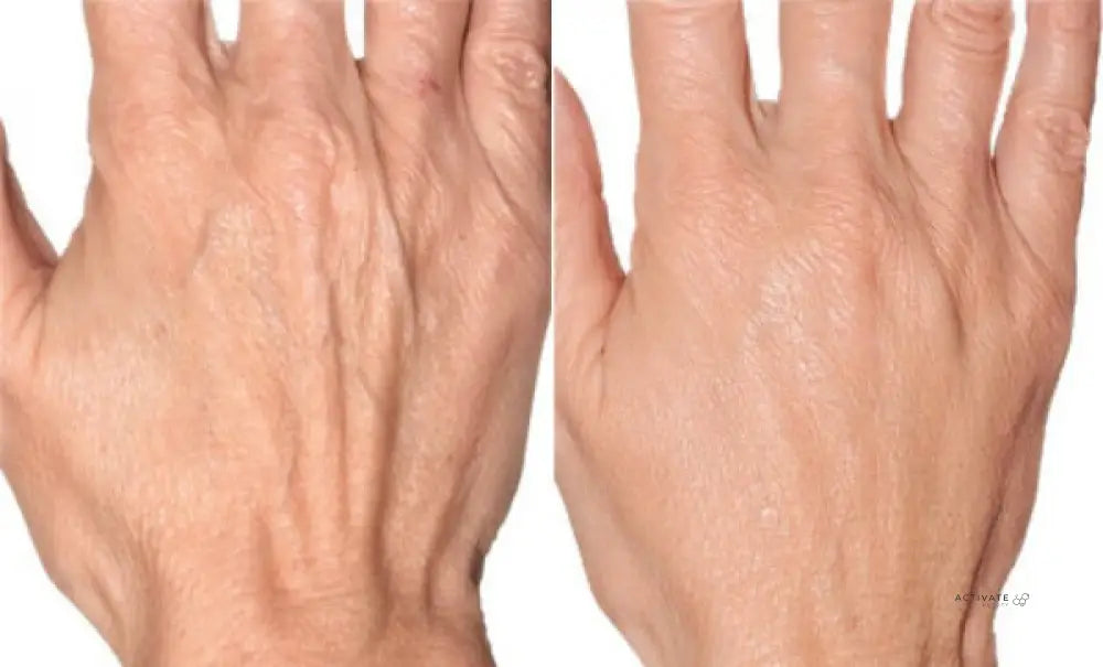 Biorevitalization Treatment For Hands Procedurs