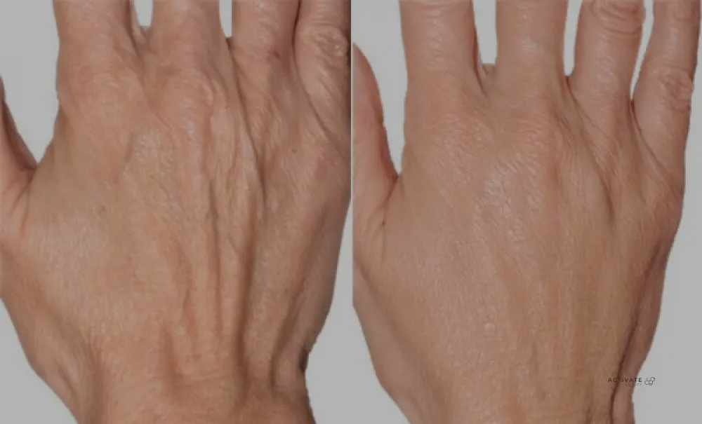 Biorevitalization Treatment for hands