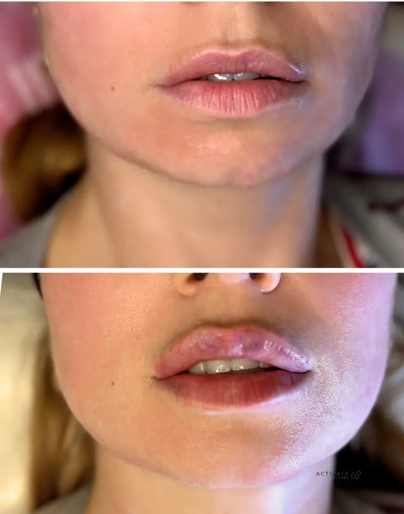 Lip Augmentation Procedurs