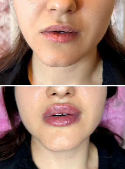 Lip Augmentation Procedurs