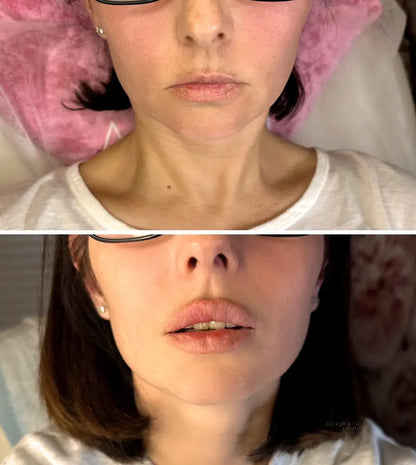 Lip Augmentation Procedurs