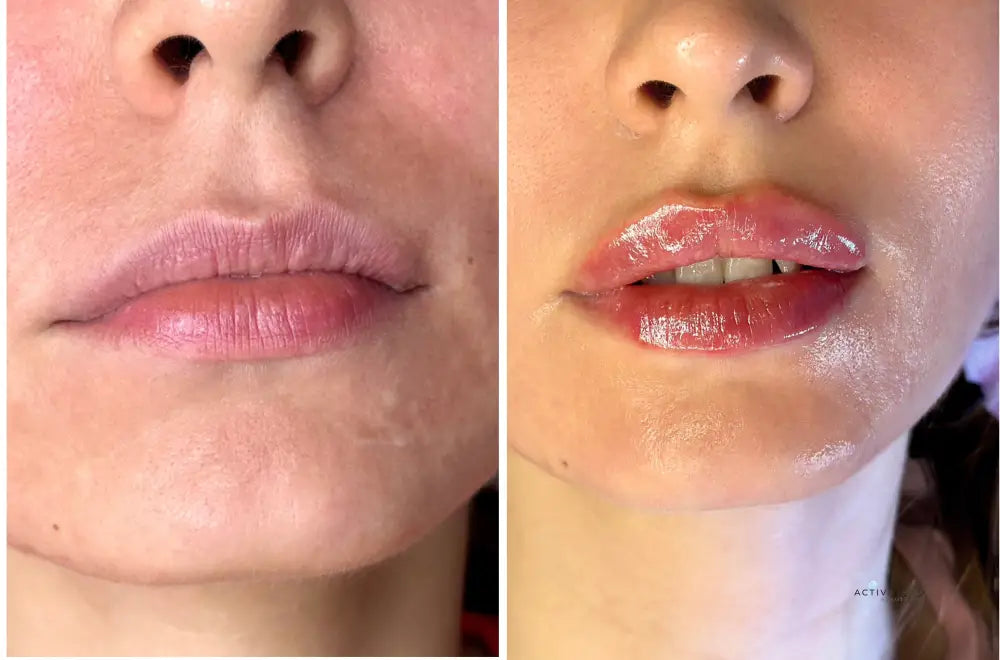 Lip Augmentation Procedurs