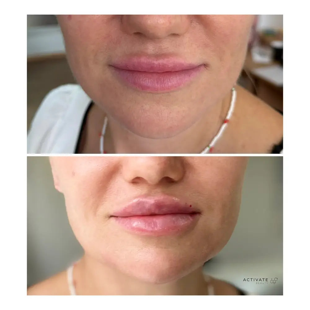 Lip Augmentation Procedurs