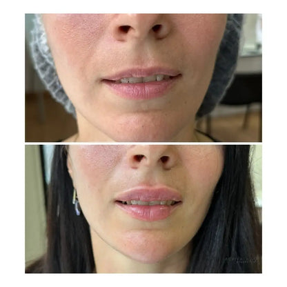 Lip Augmentation Procedurs