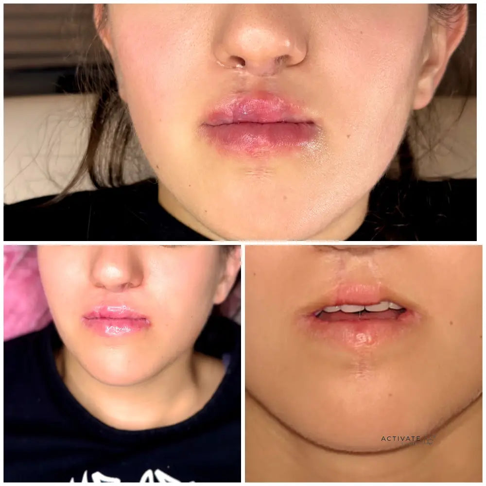 Lip Augmentation Procedurs