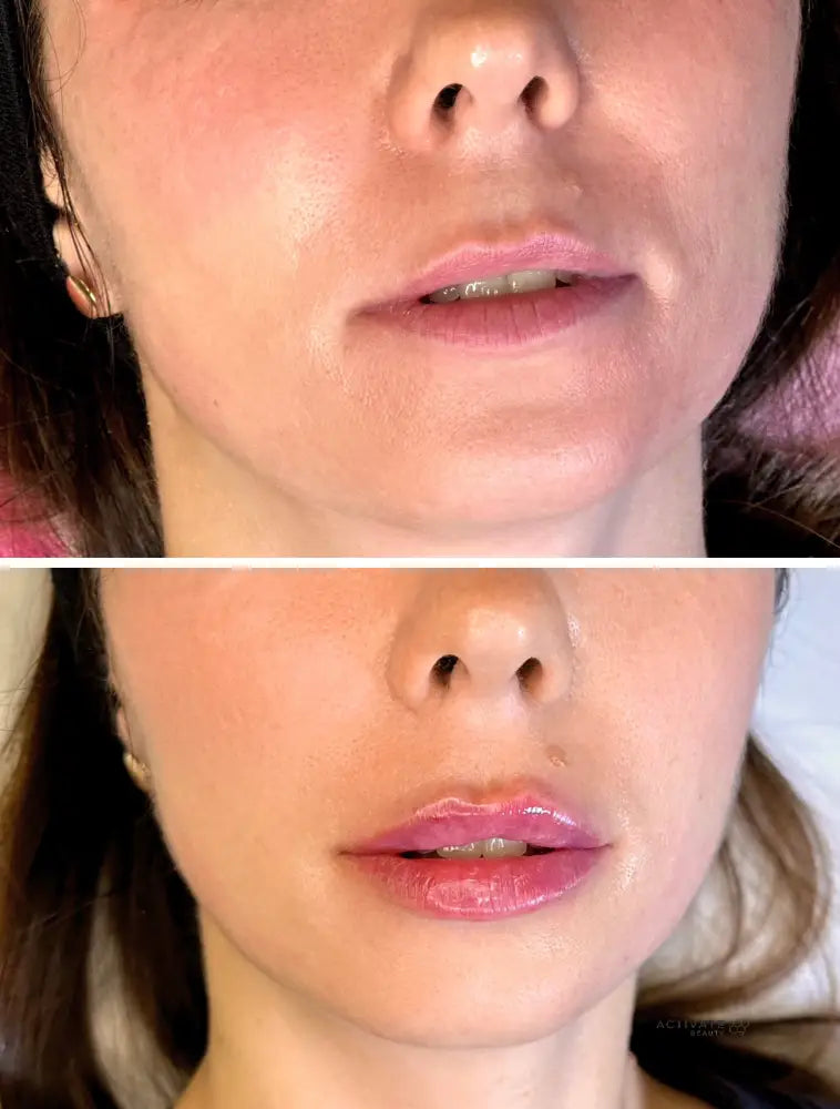 Lip Augmentation Procedurs