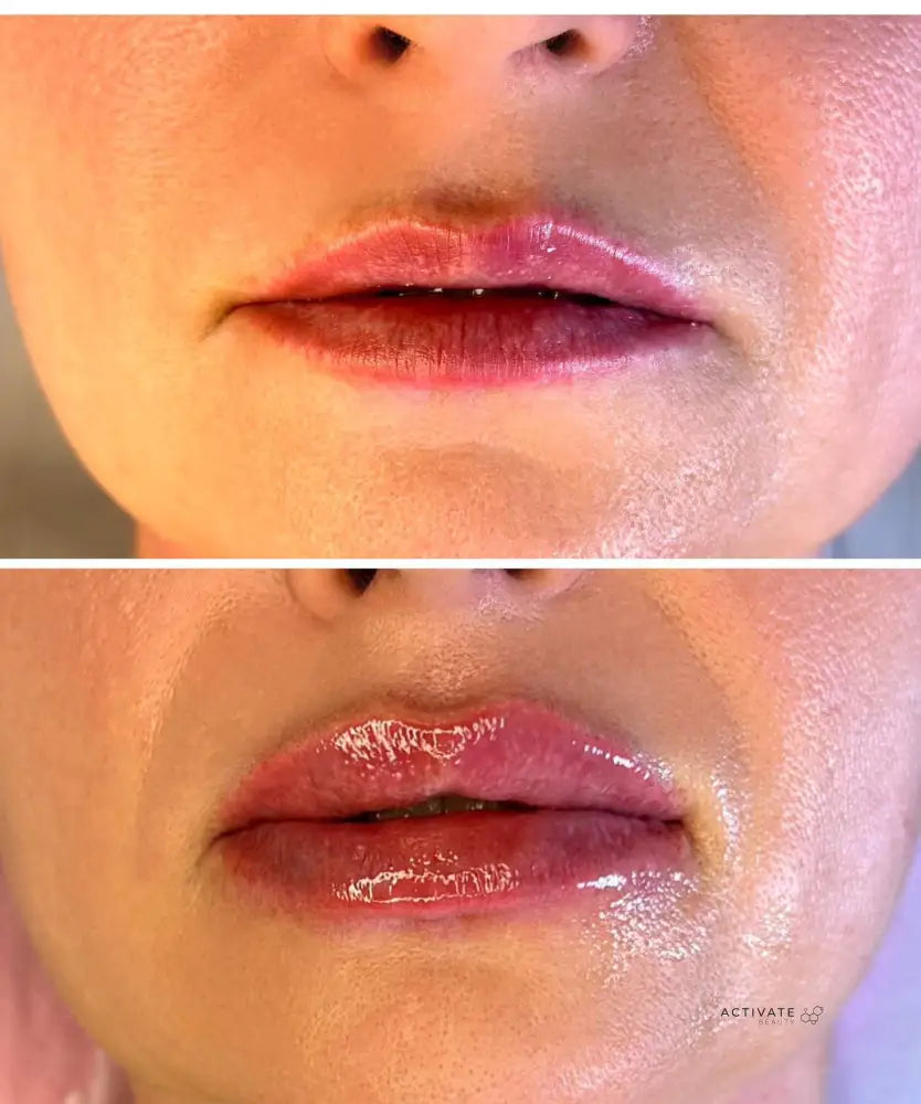 Lip Augmentation Procedurs