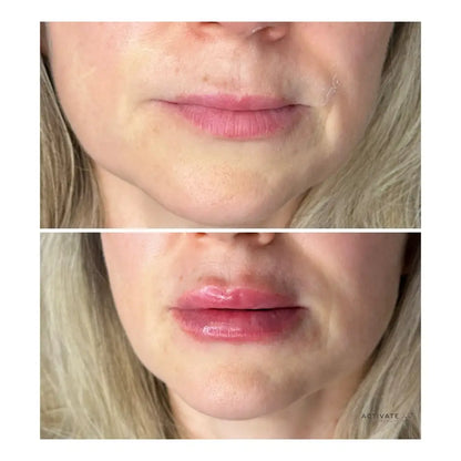 Lip Augmentation Procedurs