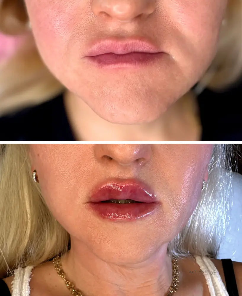 Lip Augmentation Procedurs