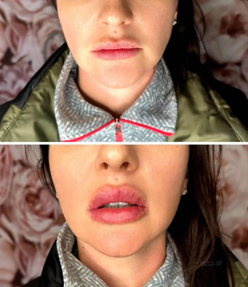 Lip Augmentation Procedurs