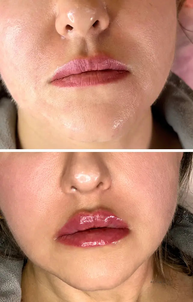 Lip Augmentation Procedurs