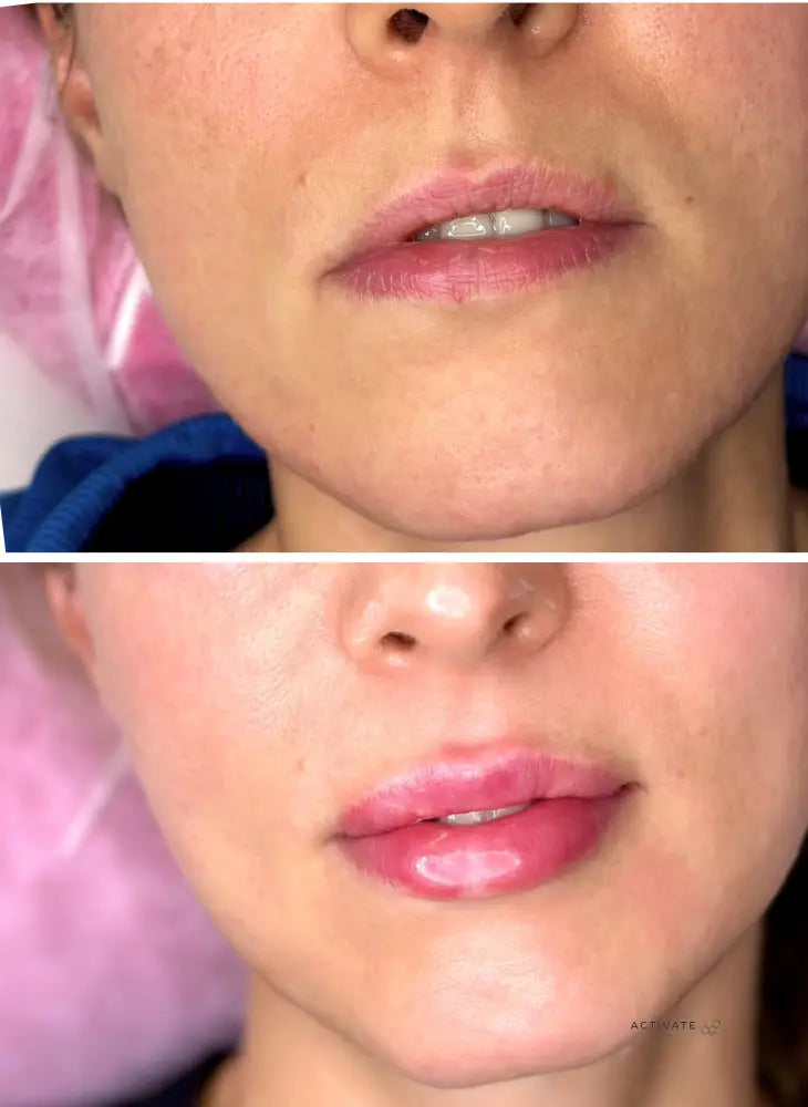 Lip Augmentation Procedurs