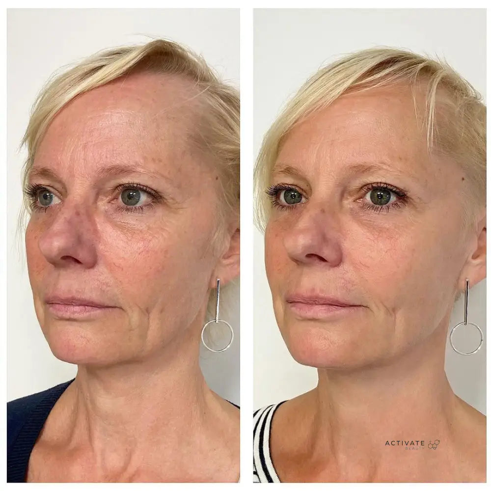 Liquid Facelift Skin Booster Plla (Sculptra) + Ha Procedurs