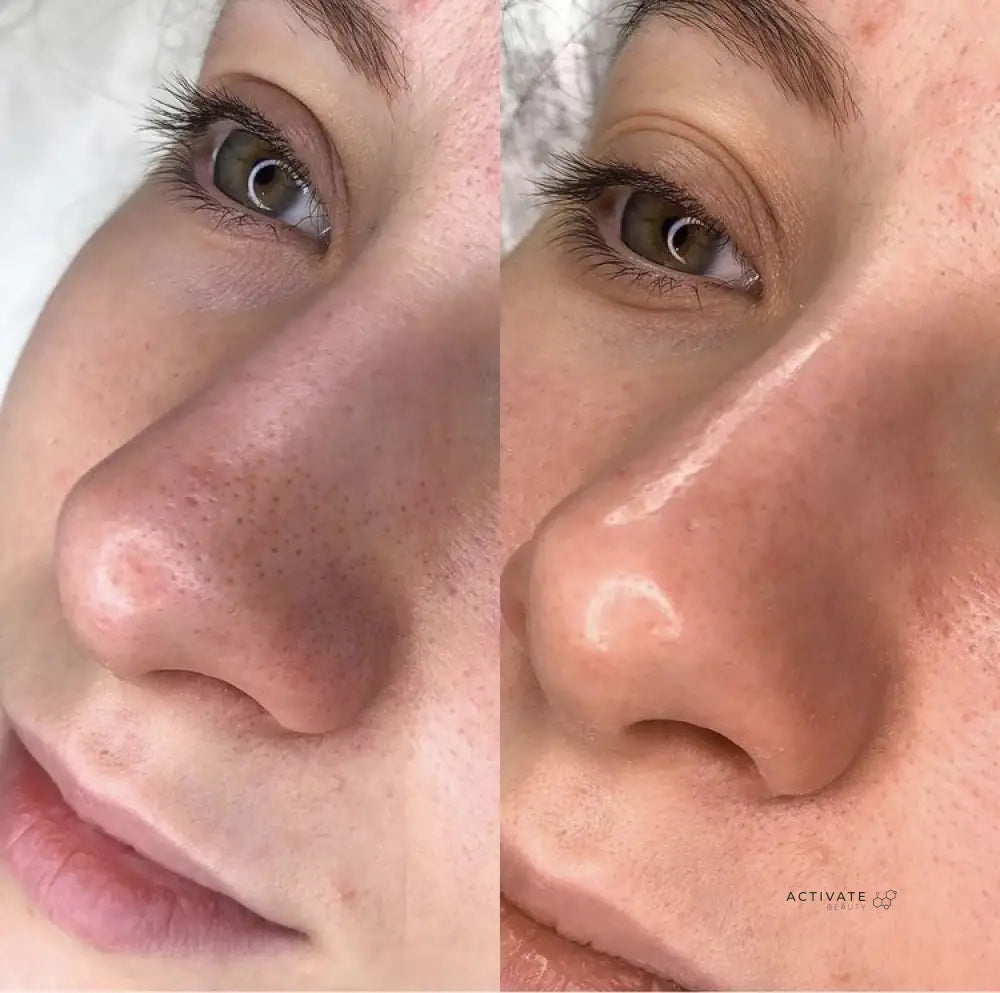 Microdermabrasion With Light Extractions Procedurs