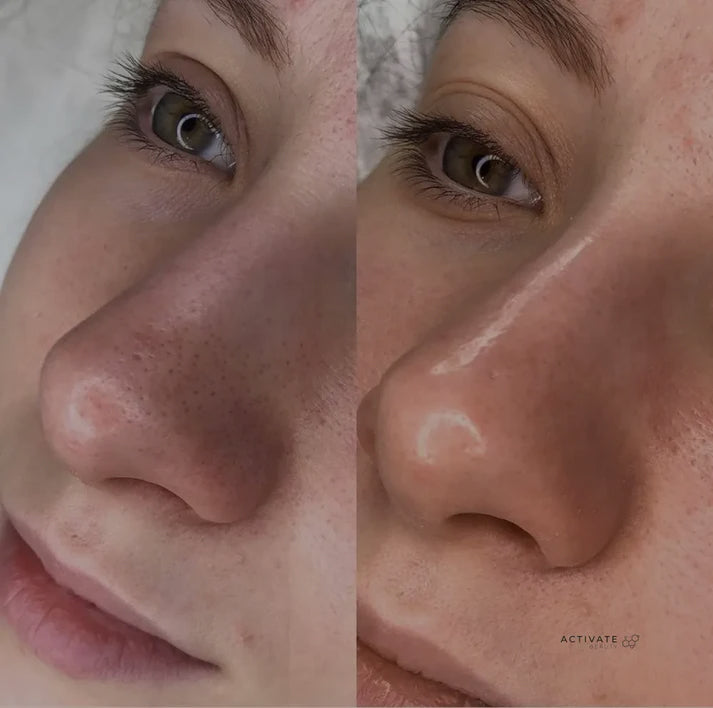 Microdermabrasion with light extractions