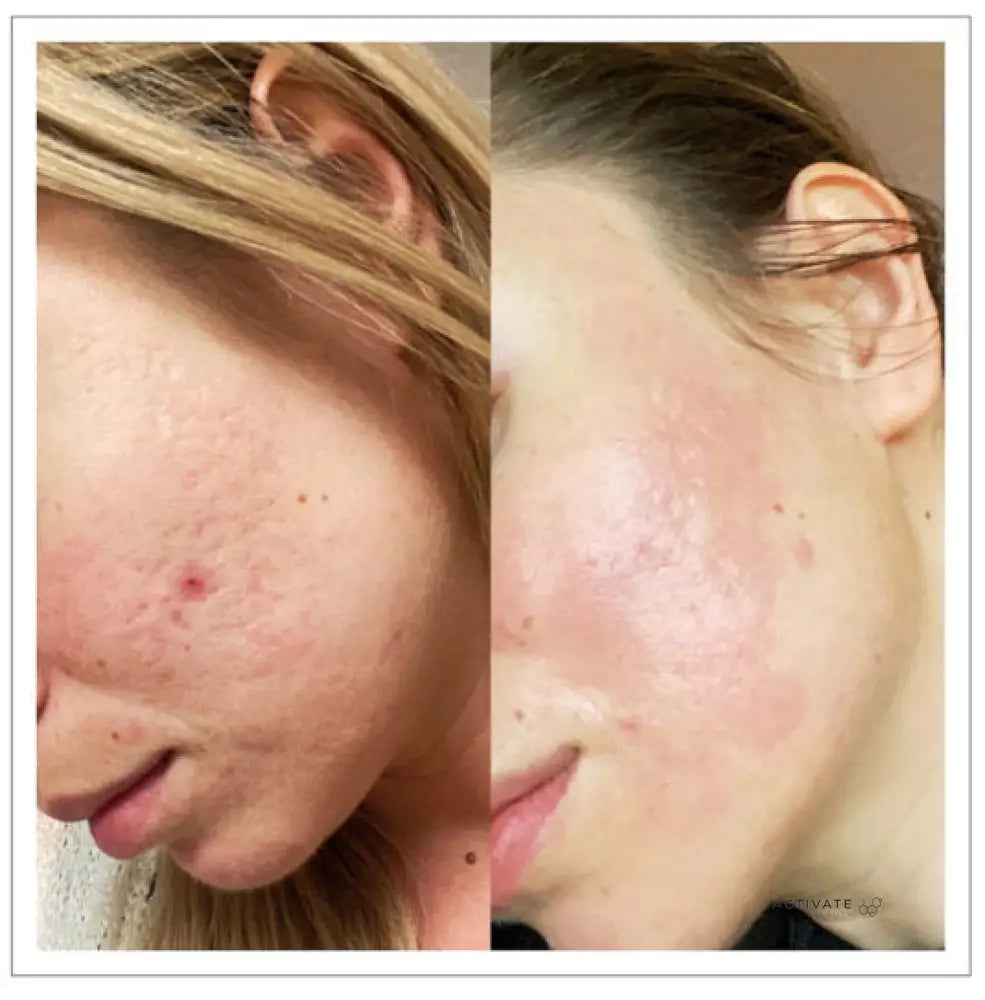 Microneedling With Exosomes / Mesococktail Procedurs