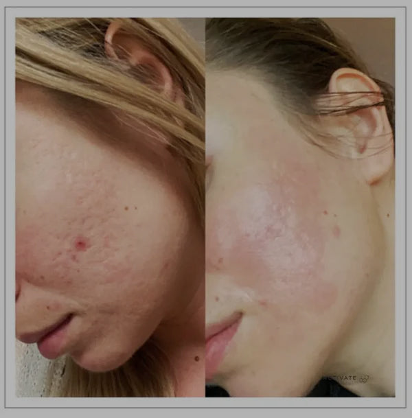 Microneedling with Exosomes / Mesococktail