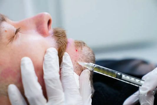 Prp & Mesotherapy For Beard Growth Procedurs