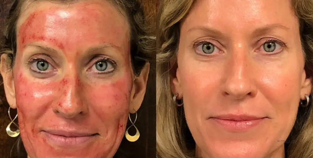 Prp Platelet Rich Plasma Facelift / Facial Procedurs