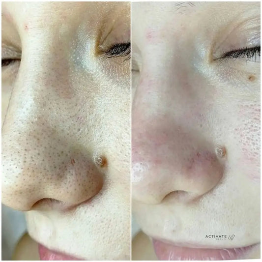 Ukrainian Deep Cleansing Facial With Extractions Procedurs