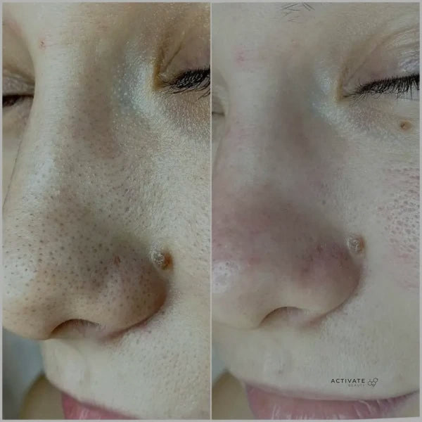 Ukrainian Deep Cleansing Facial with extractions