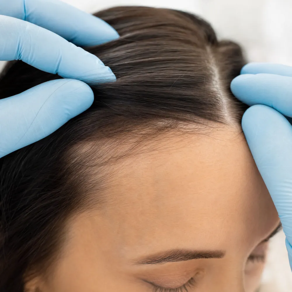 Scalp and hairline detail during a hair restoration treatment at Activate Beauty in Toronto.