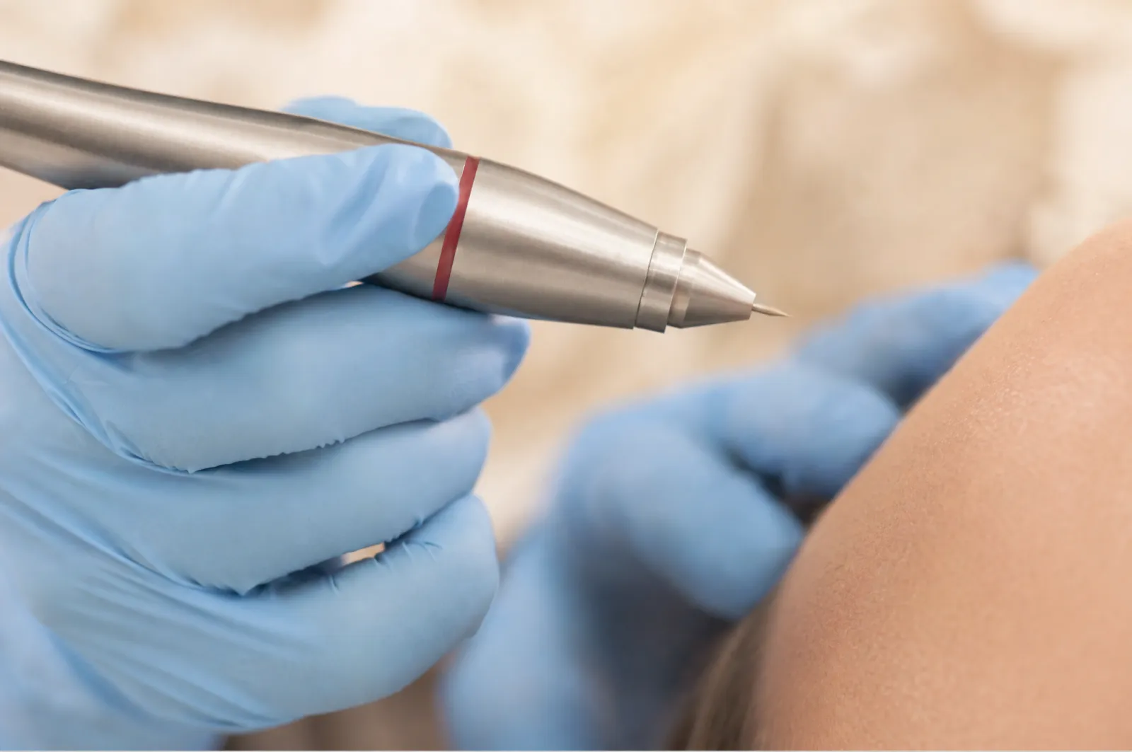 Plasma-pen (Plexr) skin treatment device.