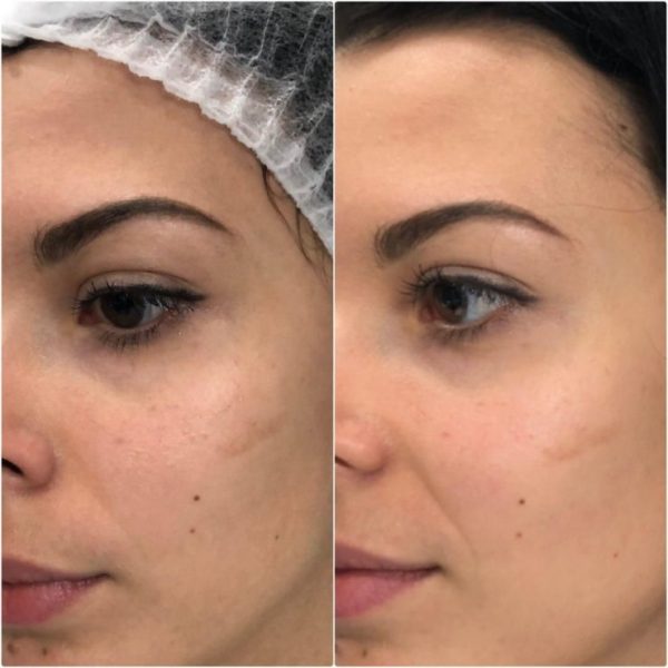 Non Injectional Mesotherapy