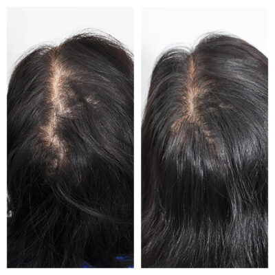 Mesotherapy for follicle activation and hair re-growth 3 sessions
