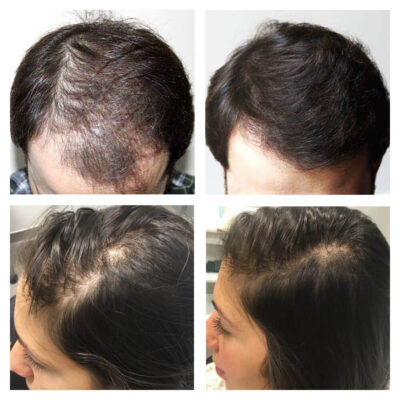 PRP Hair Restoration treatments 3 sessions