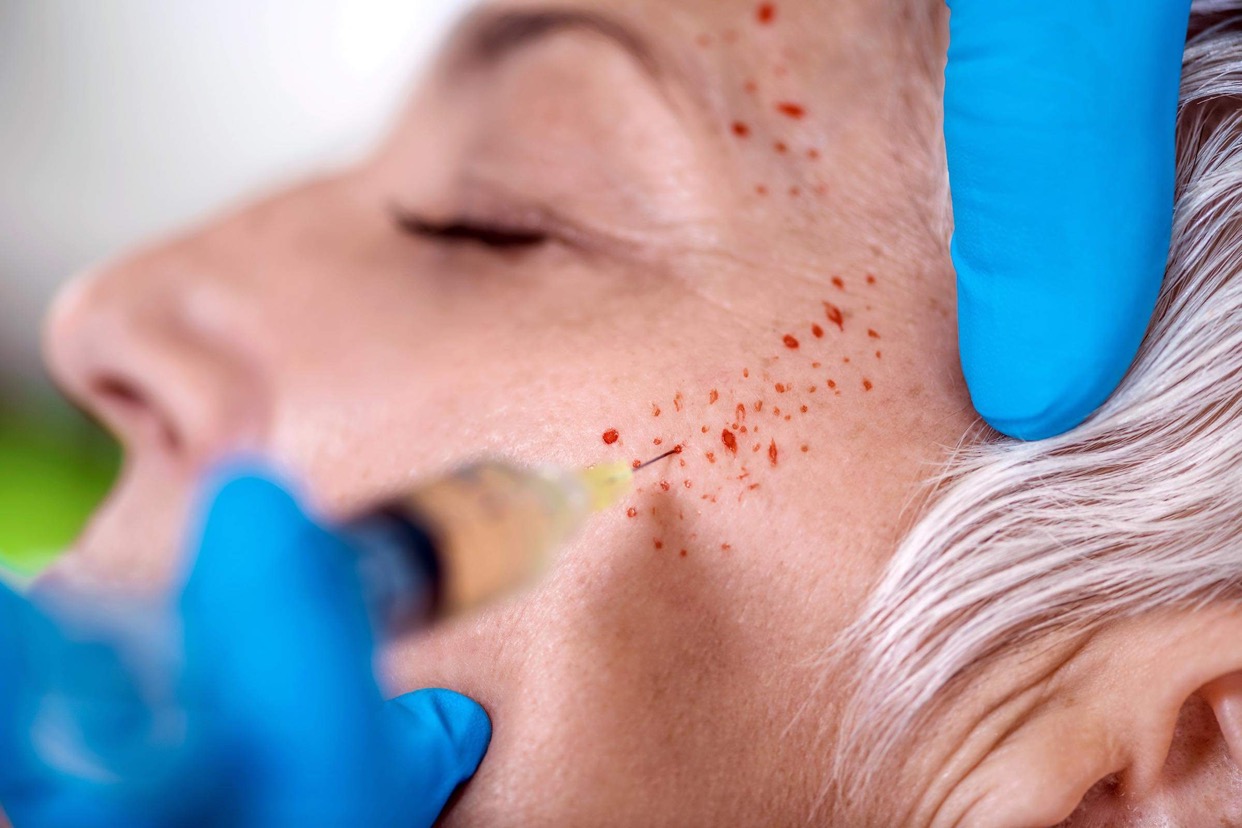 PRP Vampire Facials ( Vampire Face Lift)with Hyaluronic Acid